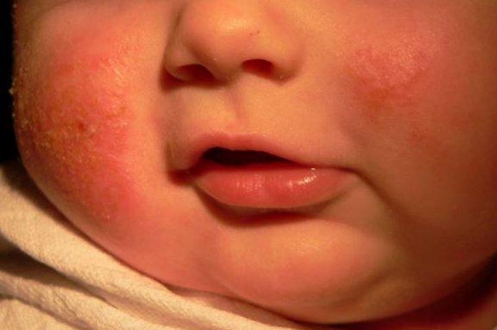 Dermatitis atopik menyerang anak